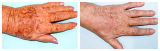 Dłonie - usuwanie przebarwień laserem przed i po zabiegu