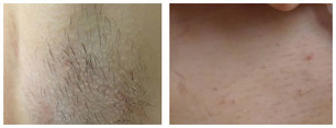 Epilacja laserowa przed i po zabiegu