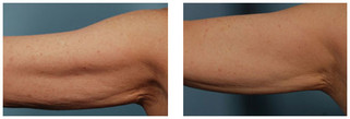 Exilis - odmładzanie twarzy / likwidacja tkanki tłuszczowej / modelowanie sylwetki / ujędrnianie zwiotczałej skóry przed i po zabiegu