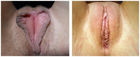 Plastyka warg sromowych mniejszych / większych przed i po zabiegu