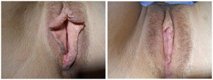 Plastyka warg sromowych mniejszych / większych przed i po zabiegu