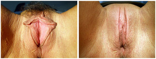 Plastyka warg sromowych mniejszych / większych przed i po zabiegu