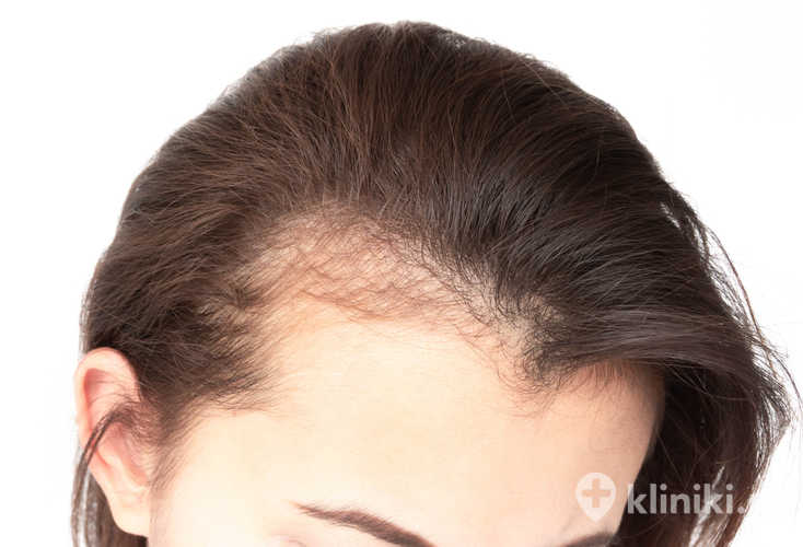 Przeszczep włosów u kobiet jest skuteczną metodą odbudowy ubytków spowodowanych łysieniem androgenowym lub bliznowaciejącym