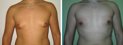 Chirurgiczne leczenie ginekomastii tłuszczowej przed i po zabiegu
