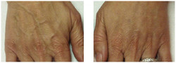 Dłonie - wypełnianie zmarszczek preparatem Radiesse przed i po zabiegu