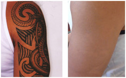 Duży tatuaż - usuwanie laserem przed i po zabiegu