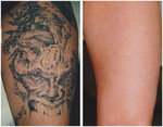 Duży tatuaż - usuwanie laserem przed i po zabiegu