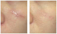 Zabiegi z użyciem lasera przed i po zabiegu