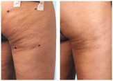 Cellulaze - zabieg laserowy do leczenia cellulitu