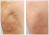 Cellulaze - zabieg laserowy do leczenia cellulitu