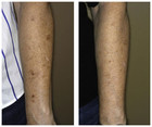 Laserowe usuwanie przebarwień skóry przed i po zabiegu