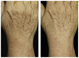 Lifting laserowy, usuwanie zwiotczenia skóry przed i po zabiegu