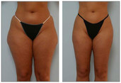 Liposukcja klasyczna SAL przed i po zabiegu