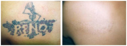 Mały tatuaż - usuwanie laserem przed i po zabiegu