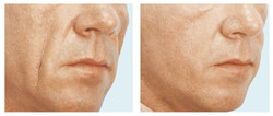 Modelowanie twarzy, wypełnienia zmarszczek preparatem Radiesse przed i po zabiegu
