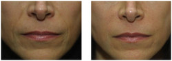 Modelowanie twarzy, wypełnienia zmarszczek preparatem Radiesse przed i po zabiegu