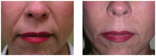 Modelowanie twarzy, wypełnienia zmarszczek preparatem Radiesse przed i po zabiegu
