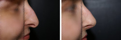 Operacja nosa chrzęstnego / czubka nosa przed i po zabiegu