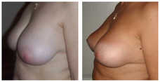 Operacje plastyczne piersi przed i po zabiegu