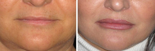 Operacje plastyczne ust przed i po zabiegu