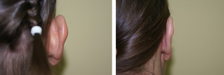 Operacje plastyczne uszu przed i po zabiegu