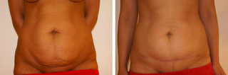 Plastyka brzucha przed i po zabiegu