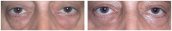 Plastyka chirurgiczna powiek dolnych i górnych przed i po zabiegu