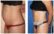 Plastyka ciała (body lifting) przed i po zabiegu