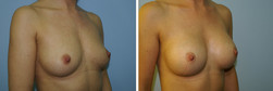 Powiększanie piersi implantami anatomicznymi przed i po zabiegu