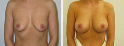 Powiększanie piersi implantami anatomicznymi przed i po zabiegu