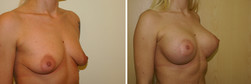 Powiększanie piersi implantami okrągłymi przed i po zabiegu