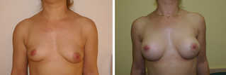 Powiększanie piersi przed i po zabiegu