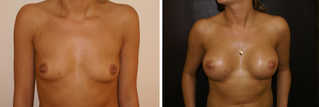 Powiększanie piersi przed i po zabiegu