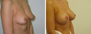 Powiększanie piersi przed i po zabiegu