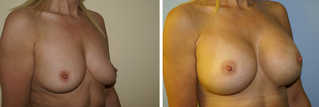 Powiększanie piersi przed i po zabiegu