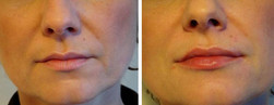 Powiększanie ust chirurgiczne przed i po zabiegu