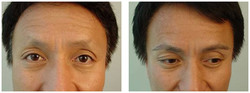 Przeszczep włosów metodą SAFER u mężczyzn przed i po zabiegu