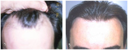 Przeszczep włosów metodą SAFER u mężczyzn przed i po zabiegu