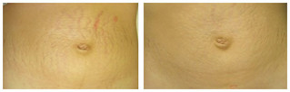 Rozstępy na brzuchu - usuwanie laserem przed i po zabiegu