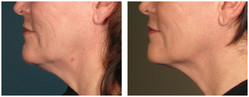 Ulthera - lifting całej twarzy, podbródka i szyi przed i po zabiegu