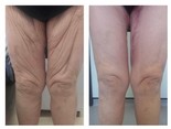 Chirurgia plastyczna ciała i modelowanie sylwetki przed i po zabiegu