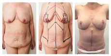 Plastyka ciała (body lifting) przed i po zabiegu