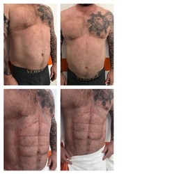 Liposukcja ultradźwiękowa Vaser Lipo - brzuch przed i po zabiegu