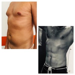 Liposukcja ultradźwiękowa Vaser Lipo - brzuch przed i po zabiegu
