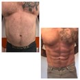 Liposukcja ultradźwiękowa Vaser Lipo - brzuch przed i po zabiegu