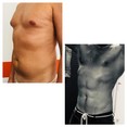 Liposukcja ultradźwiękowa Vaser Lipo przed i po zabiegu