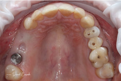 Implanty zębowe przed i po zabiegu
