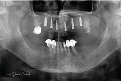 Proteza na 6 implantach przed i po zabiegu