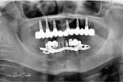 Proteza na 6 implantach przed i po zabiegu