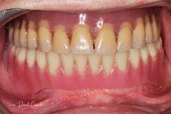 Proteza zębowa Lokator przed i po zabiegu